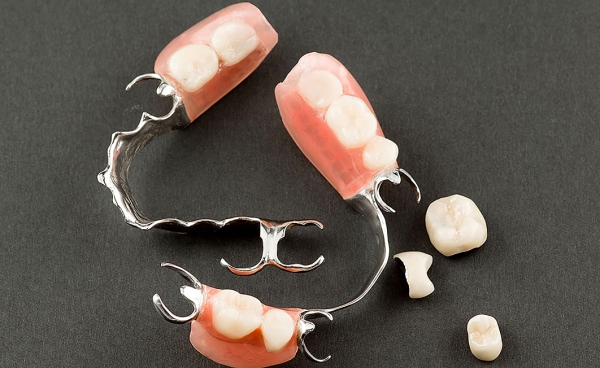 Протезирование зубов: бюгельные протезы